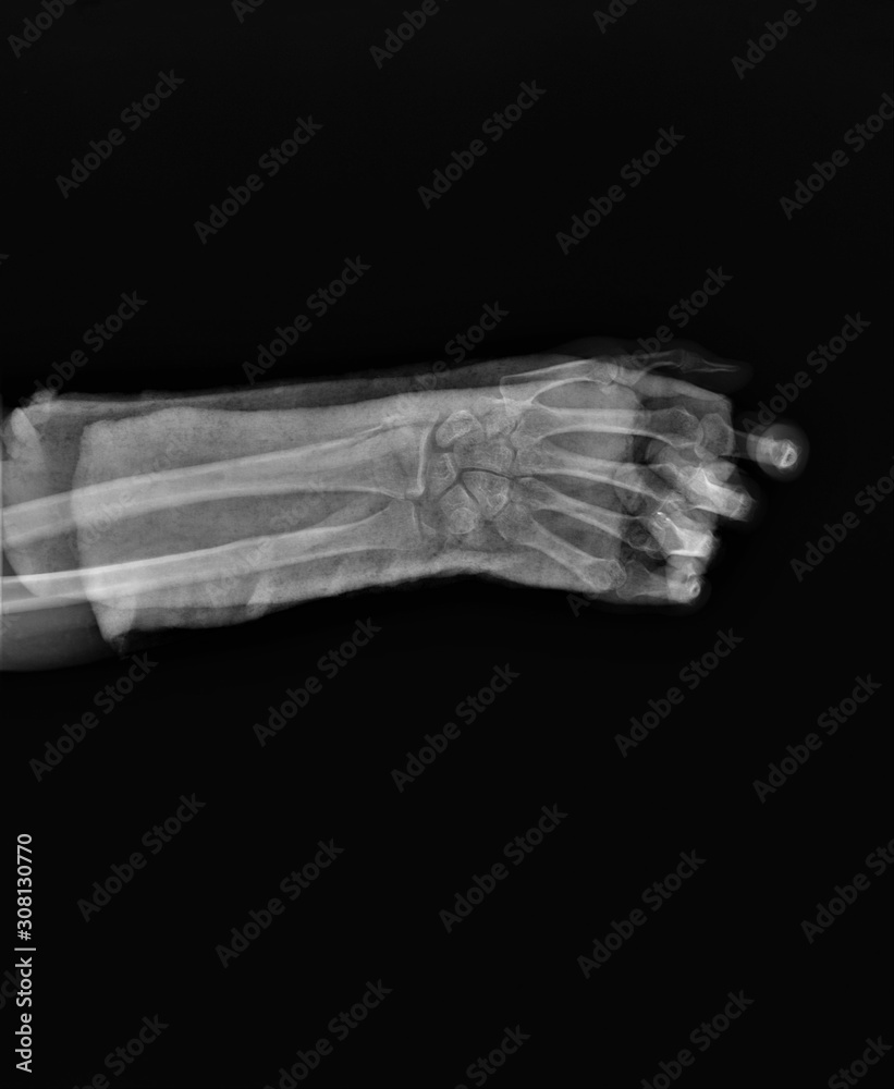 radiography of forearm and wrist bones with a fracture of the distal ...
