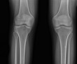 © Anton - normal radiography of the knee joint in the frontal projection medical diagnostics, Traumatology and orthopedics