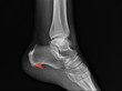 © Anton - radiograph of the ankle joint in the lateral projection, heel spur.Osteoarthritis, Osteoporosis