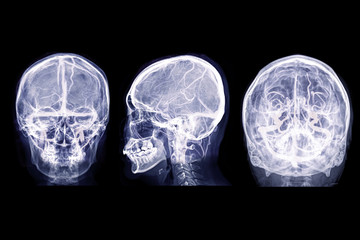 Poster - Collection of  Skull x-ray image of Human skull AP , Lateral and water view  mix with MRV Brain image showing Venous sinuses of brain in skull.