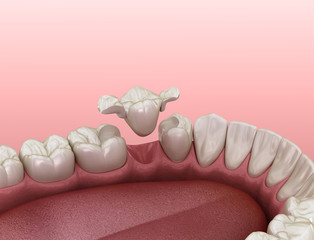 Maryland bridge made from ceramic, premolar tooth recovery. Medically accurate 3D illustration of dental concept