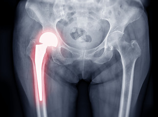 Poster - x-ray both hip ap view