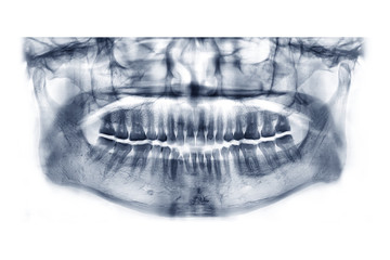 Poster - Panoramic dental x-ray image or orthopantomogram of jaw with all teeth  used in dentistry for diagnosis of diseases, disorders and conditions of the oral cavity