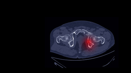 Wall Mural - CT scan(computed tomography)hip radiography show broken hip bone or fracture acetabulum(acetabular fracture disease). Patient has crushing injury. Orthopedic trauma and medical radiology concept