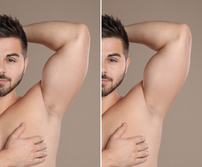 Poster - Collage of man showing armpit before and after epilation on light brown background