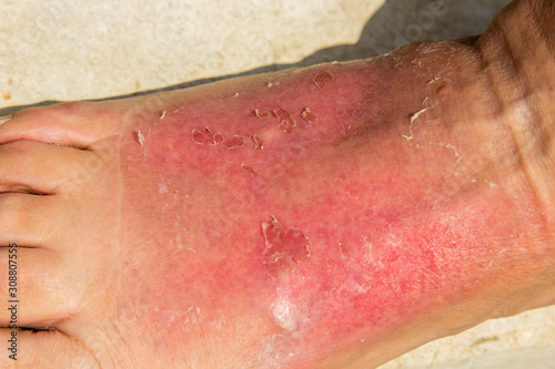 As a result of a skin burn, the woman\'s leg was swollen in the ankle region. Dermatitis, expressed by redness, peeling, and soreness after sunbathing. Sore foot bump.