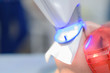 © johnalexandr - the patient undergoes a procedure for teeth whitening with an ultraviolet lamp