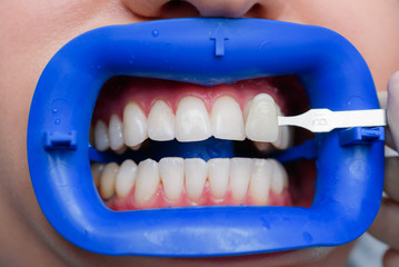 procedure for comparing the color shades of teeth with tests after bleaching