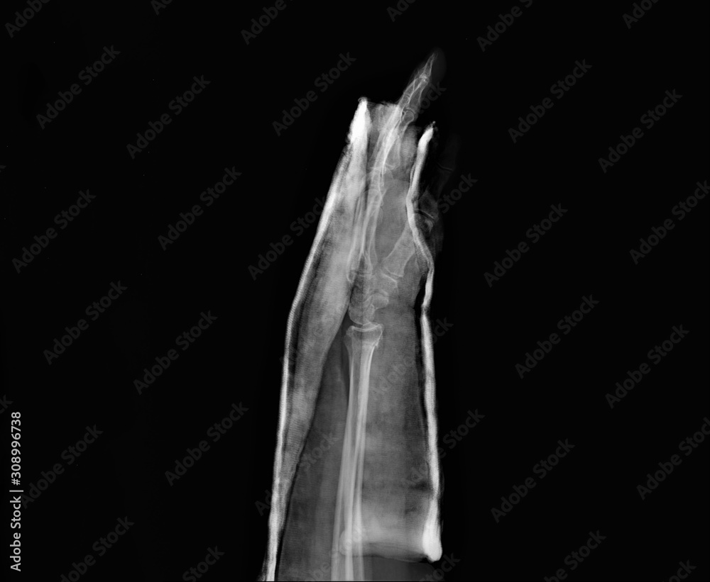 radiography of forearm and wrist bones with a fracture of the distal ...