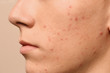 © New Africa - Teen guy with acne problem on beige background, closeup
