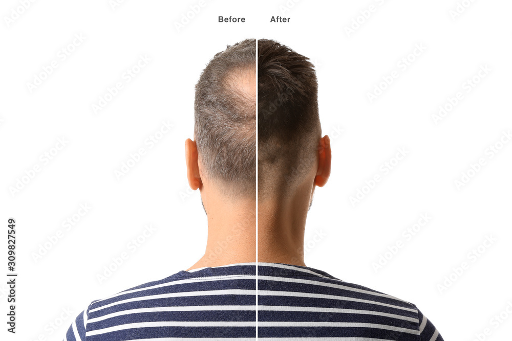 Man before and after hair loss treatment on white background - obrazy, fototapety, plakaty 
