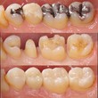 虫歯審美治療