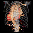 CTA thoracic aorta  3D rendering image posterior view or back view for diagnotic abdominal aortic aneurysm or AAA and aortic dissection