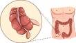 Vector illustration of a with detail of an appendicitis