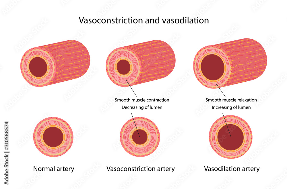 Arterial vasoconstriction and vasodilation. Comparison illustration of ...