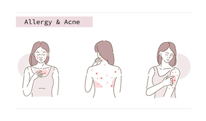 Beauty Girl Have Allergy and Acne Skin Problems. Woman Scratching her Body and Face with Hand. Allergic Dermatitis, Eczema or Nettle Rash with Itch Symptoms.  Flat Line Cartoon Vector Illustration.