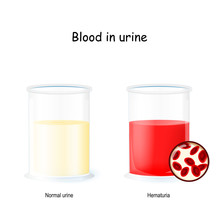 Normal And Bloody Urine. Two Beaker With Urine. Hematuria Is The Presence Of Red Blood Cells In The Urine