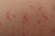 Close up of contact dermatitis rash and skin bumps in Caucasian skin as a result of an allergic reaction