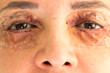 © Marcos - Woman who had eyelift surgery performed on both eyes