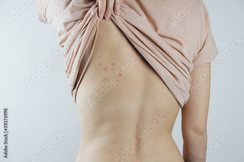 Damaged Skin On Female S Back Bedbug Bites Moosquito Bites Or Skin Disease On Human Body Stock Photo Adobe Stock