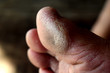 © meawdari - Picture of dry and cracked toes, unattractive