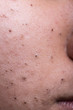 © ThamKC - Ugly pimples blackheads on cheek face of teenager
