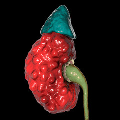 Sticker - Chronic pyelonephritis, 3D illustration showing irregular scarred cortical surface particularly at poles and dilated ureter