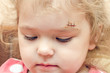 © andrei310 - A little girl with a scar above her eyebrow, a deep wound sewn up