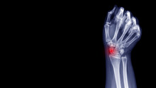 Film X-ray Wrist Radiograph Show Carpal Bone Broken (scaphoid Fracture) From Falling. Highlight On Broken Site And Painful Area.  Medical Imaging And Orthopedic Technology Concept