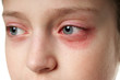 © soleg - Allergic reaction, skin rash, close view portrait of a girl's face. Redness and inflammation of the skin in the eyes and lips. Immune system disease.