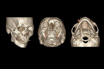Poster - CT Facial Bone 3D rendering  image isolated on black background showing fracture frontal bone .