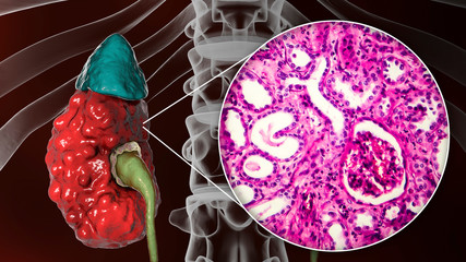 Poster - Chronic pyelonephritis, 3D illustration showing gross morphology with irregular scarred cortical surface and light micrograph showing interstitial fibrosis and inflammation