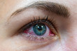 © munole - One female eye with red protein from allergic conjunctivitis