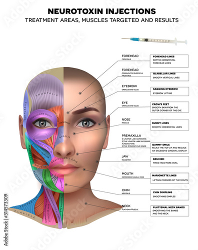Neurotoxin injections treatment areas, muscles targeted and results Fototapeta