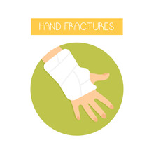 Illustration Of A Fractured Hand With A Cast.