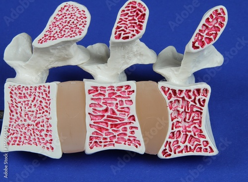 Cuadros en Lienzo Model of spine showing porous bone marrow in case of osteoporosis