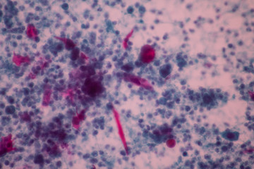 View in microscopic of abnormal cervical or vagina cells.Squamous epithelium cells.Squamous cell carcinoma.Cytology and pathology laboratory department.Magnification 400 X