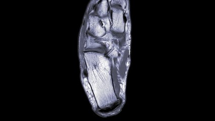 Poster - mri ankle axial pdw sequence for diagnostic tendon of ankle injury.