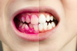 Plaque disclosing tablets in work. Before and after - effect. close up photo of young boy tooth. Dental plaque pill concept