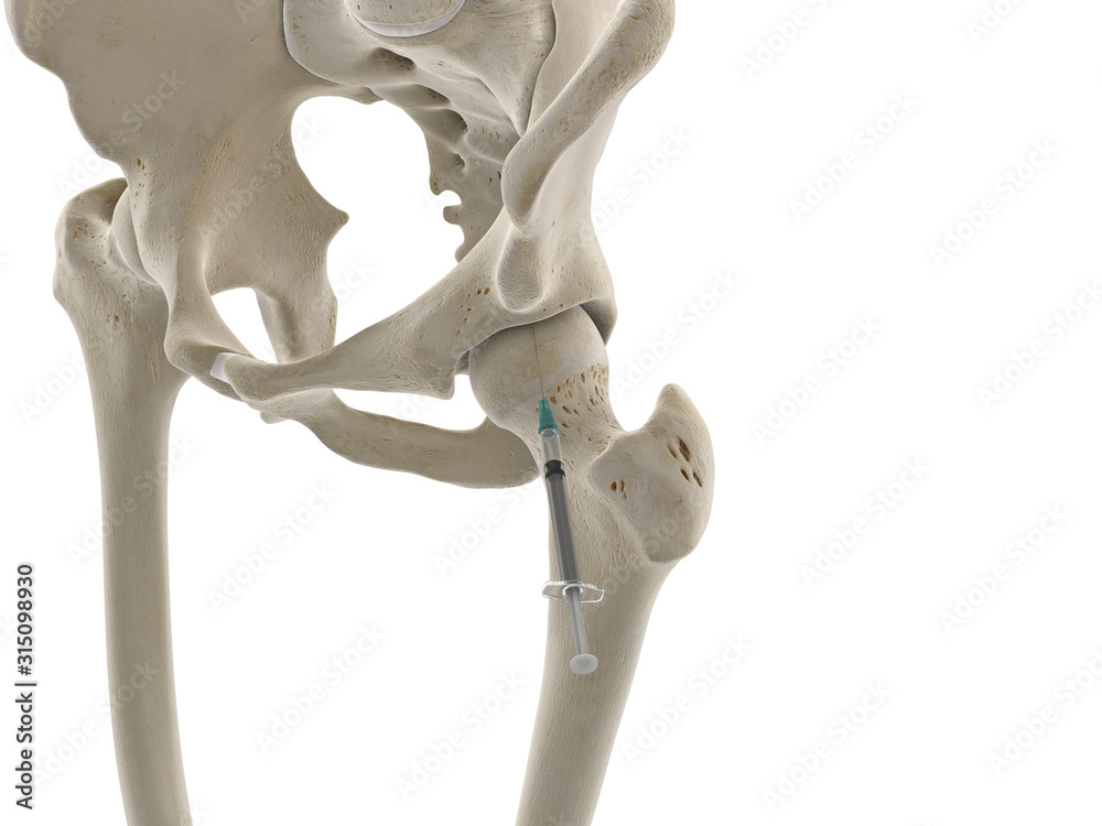 3d rendered medically accurate illustration of a hip joint injection ...