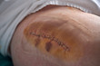 © PHILIPPE DEGROOTE/ADDICTIVE STOCK - Clean large suture with staples bruises on thigh of anonymous patient after surgery in hospital