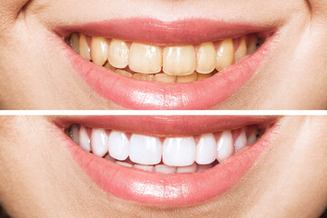 woman teeth before and after whitening. Over white background. Dental clinic patient. Image symbolizes oral care dentistry, stomatology