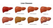 Healthy Liver and Liver diseases - fatty liver, hepatitis, fibrosis, cirrhosis, alcoholic hepatitis, liver cancer - medical infographic elements isolated on white background.