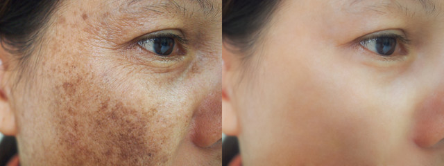 Wall Mural - Image before and after spot melasma pigmentation facial treatment on face asian woman.Problem skincare and health concept.