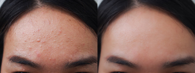 Image before and after acne pimple treatment on the face of young Asian woman.Problem skincare and beauty concept.