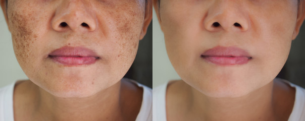 Image before and after spot melasma pigmentation facial treatment on face asian woman.Problem skincare and health concept.