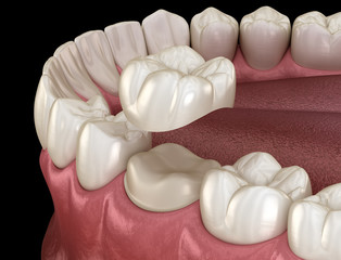 Wall Mural - Preparated molar tooth for dental crown placement. Medically accurate 3D illustration
