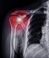 Poster - x-ray shoulder joint for diagnosis shoulder joint dislocation.