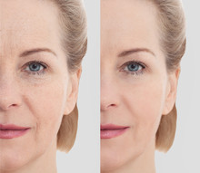 Middle Age Close Up Woman Happy Face Before After Cosmetic Procedures. Skin Care For Wrinkled Face. Before-after Anti-aging Facelift Treatment. Facial Skincare And Contouring.