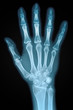 X-ray of a human hand